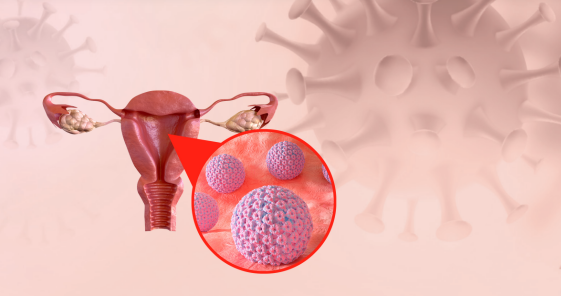 Cancer du col de l'utérus Réalisez votre auto-prélèvement vaginal du Papillomavirus (HPV) à domicile